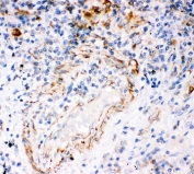 IHC-P: IP3R antibody testing of human lung cancer tissue. HIER: steam section in pH6 citrate buffer for 20 min.