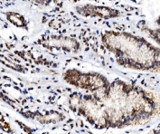 IHC staining of FFPE human gastric cancer tissue with Glucocorticoid receptor antibody. HIER: boil tissue sections in pH8 EDTA for 20 min and allow to cool before testing.