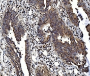 IHC staining of FFPE human rectal cancer tissue with Glucocorticoid receptor antibody. HIER: boil tissue sections in pH8 EDTA for 20 min and allow to cool before testing.