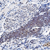 IHC staining of FFPE human gastric cancer tissue with Glucocorticoid receptor antibody. HIER: boil tissue sections in pH8 EDTA for 20 min and allow to cool before testing.