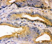IHC-P: ZO-1 antibody testing of human intestinal cancer tissue. HIER: steamed with pH6 citrate buffer.