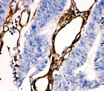 IHC-P: HSP27 antibody testing of human intestine cancer tissue
