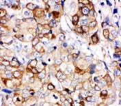 IHC staining of FFPE human breast cancer tissue with HSP27 antibody. HIER: boil tissue sections in pH6, 10mM citrate buffer, for 10-20 min and allow to cool before testing.