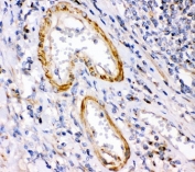 IHC-P: Calretinin antibody testing of human intestine cancer tissue