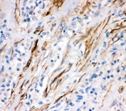 IHC-P: Fas antibody testing of human lung cancer tissue