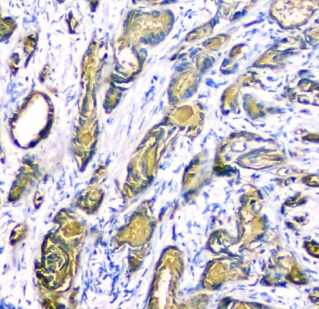 IHC staining of FFPE human prostate cancer tissue with c-Kit antibody. HIER: boil tissue sections in pH8 EDTA for 20 min and allow to cool before testing.~