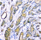 IHC staining of FFPE human prostate cancer tissue with c-Kit antibody. HIER: boil tissue sections in pH8 EDTA for 20 min and allow to cool before testing.