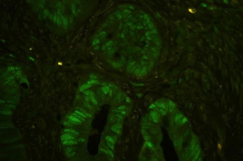 Immunofluorescent staining of FFPE human colon cancer tissue with MCM7 antibody. HIER: steam section in pH6 citrate buffer for 20 min.