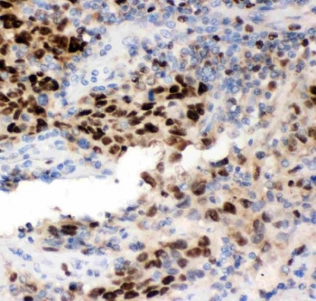 IHC staining of FFPE human lung cancer tissue with MCM7 antibody. HIER: boil tissue sections in pH8 EDTA for 20 min and allow to cool before testing.