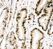 IHC staining of FFPE human colorectal cancer tissue with MGMT antibody. HIER: boil tissue sections in pH8 EDTA for 20 min and allow to cool before testing.