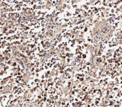 IHC staining of FFPE human lung cancer tissue with MIF antibody. HIER: boil tissue sections in pH8 EDTA for 20 min and allow to cool before testing.