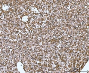 IHC staining of FFPE human liver cancer tissue with MIF antibody. HIER: boil tissue sections in pH8 EDTA for 20 min and allow to cool before testing.
