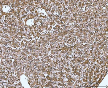 IHC staining of FFPE human liver cancer tissue with MIF antibody. HIER: boil tissue sections in pH8 EDTA for 20 min and allow to cool before testing.