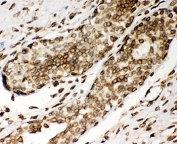 IHC-P: Lamin A antibody testing of human breast cancer tissue. HIER: steamed with pH6 citrate buffer.