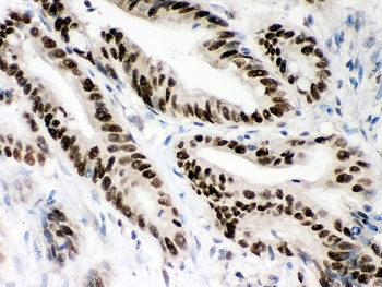 IHC-P: MSH2 antibody testing of human intestine cancer tissue. HIER: steamed with pH6 citrate buffer.