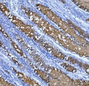 IHC staining of FFPE human gastric carcinoma tissue with MUC5AC antibody. HIER: boil tissue sections in pH8 EDTA for 20 min and allow to cool before testing.