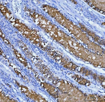 IHC staining of FFPE human gastric carcinoma tissue with MUC5AC antibody. HIER: boil tissue sections