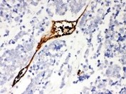 IHC-P: Mesothelin antibody testing of human lung cancer tissue. HIER: steamed with pH6 citrate buffer.