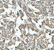 IHC staining of FFPE human breast cancer tissue with c-Myb antibody. HIER: boil tissue sections in pH8 EDTA for 20 min and allow to cool before testing.