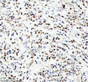 IHC staining of FFPE human breast cancer tissue with NEDD9 antibody. HIER: boil tissue sections in pH8 EDTA for 20 min and allow to cool before testing.