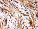 IHC staining of FFPE human intestinal cancer tissue with IkB beta antibody, HRP-secondary and DAB substrate. HIER: boil tissue sections in pH8 EDTA for 20 min and allow to cool before testing.