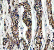 IHC staining of FFPE human breast cancer tissue with IkB beta antibody, HRP-secondary and DAB substrate. HIER: boil tissue sections in pH8 EDTA for 20 min and allow to cool before testing.