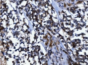 IHC staining of FFPE human lung cancer tissue with NUMB antibody. HIER: boil tissue sections in pH8 EDTA for 20 min and allow to cool before testing.