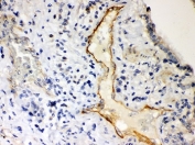 IHC-P: P2X2 antibody testing of human lung cancer tissue