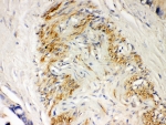 IHC-P: Parkin antibody testing of human intestinal cancer tissue. HIER: steamed with pH6 citrate buffer.