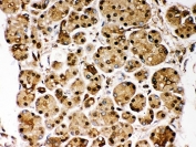 IHC-P: DJ-1 antibody testing of human pancreatic cancer tissue. HIER: steamed with pH6 citrate buffer.