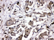IHC staining of FFPE human breast cancer with PKC alpha antibody at 1ug/ml. HIER: boil tissue sections in pH6, 10mM citrate buffer, for 10-20 min and allow to cool before testing.