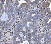 IHC staining of FFPE human endometrial adenocarcinoma tissue with HSP47 antibody. HIER: boil tissue sections in pH8 EDTA for 20 min and allow to cool before testing.