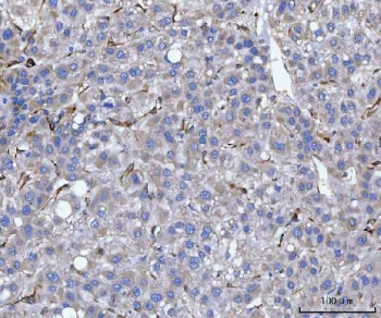 IHC staining of FFPE human liver cancer tissue with HSP47 antibody. HIER: boil tissue sections in pH8 EDTA for 20 min and allow to cool before testing.