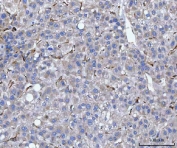 IHC staining of FFPE human liver cancer tissue with HSP47 antibody. HIER: boil tissue sections in pH8 EDTA for 20 min and allow to cool before testing.