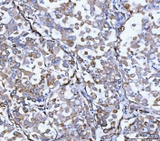IHC staining of FFPE human lung adenocarcinoma tissue with HSP47 antibody. HIER: boil tissue sections in pH8 EDTA for 20 min and allow to cool before testing.