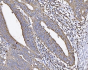 IHC staining of FFPE human rectal cancer tissue with ATP5H antibody. HIER: boil tissue sections in pH8 EDTA for 20 min and allow to cool before testing.