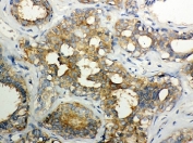 IHC-P: Calpain 1 antibody testing of human breast cancer tissue