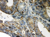 IHC staining of FFPE human intestinal cancer with CD44 antibody. HIER: boil tissue sections in pH6, 10mM citrate buffer, for 10-20 min and allow to cool before testing.