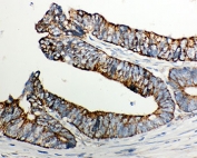IHC-P: Cytochrome C antibody testing of human intestinal cancer tissue. HIER: steamed with pH6 citrate buffer.