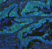 Immunofluorescent staining of FFPE human intestinal cancer tissue with Cytochrome C antibody (green) at 1ug/ml and DAPI nuclear stain (blue). HIER: steam section in pH6 citrate buffer for 20 min.