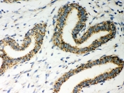 IHC-P: ERAB antibody testing of human breast cancer tissue. HIER: steam section in pH6 citrate buffer for 20 min and allow to cool prior to testing.