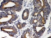 IHC-P: HSP60 antibody testing of human intestine cancer tissue. HIER: steamed with pH6 citrate buffer.