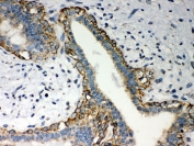 IHC-P: LYRIC antibody testing of human breast cancer tissue. HIER: steam section in pH6 citrate buffer for 20 min and allow to cool prior to testing.