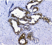 IHC staining of FFPE human breast cancer with NMI antibody. HIER: boil tissue sections in pH8 EDTA for 20 min and allow to cool before testing.