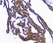 IHC staining of FFPE human breast cancer with NMI antibody. HIER: boil tissue sections in pH8 EDTA for 20 min and allow to cool before testing.