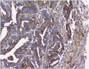 IHC staining of FFPE human colon cancer with NMI antibody. HIER: boil tissue sections in pH8 EDTA for 20 min and allow to cool before testing.