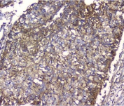 IHC staining of FFPE human lung cancer with NMI antibody. HIER: boil tissue sections in pH8 EDTA for 20 min and allow to cool before testing.