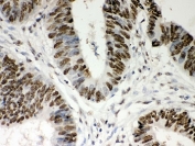 IHC staining of FFPE human intestinal cancer tissue with Nucleophosmin antibody. HIER: boil tissue sections in pH8 EDTA for 20 min and allow to cool before testing.