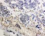 IHC-P: GR antibody testing of human lung cancer tissue