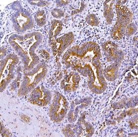IHC staining of FFPE human adenosquamous carcinoma of the gall bladder with Optineurin antibody. HIER: boil tissue sections in pH8 EDTA for 20 min and allow to cool before testing.